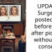 UPDATE: Surgeon posted my before and after pictures without my consent