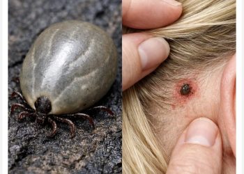 A Strange Bug in Your Child’s Hair? Here’s What Parents Need to Kn