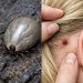 A Strange Bug in Your Child’s Hair? Here’s What Parents Need to Kn